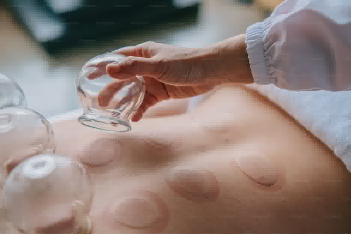 Glass cups applied along a patient's back during fire cupping